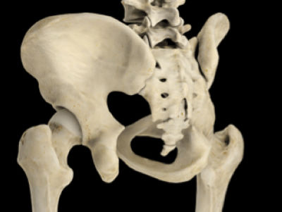 世界首例醫(yī)療3D打印應(yīng)用案例 3D打印假體骶椎成功植入