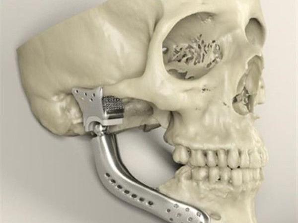 簡述3D打印技術(shù)在醫(yī)療行業(yè)應(yīng)用情況_e鍵3D打印服務(wù) 簡述3D打印技術(shù)在醫(yī)療行業(yè)應(yīng)用情況_e鍵3D打印服務(wù)