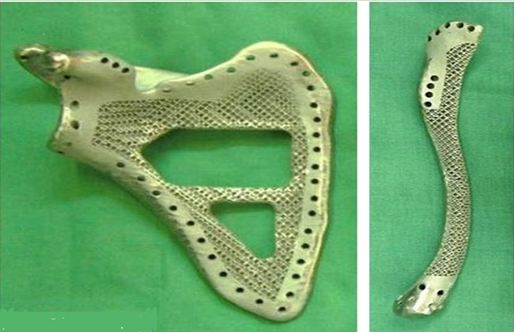 3d打印應(yīng)用領(lǐng)域之醫(yī)療應(yīng)用_e鍵打印服務(wù)公司 3d打印應(yīng)用領(lǐng)域之醫(yī)療應(yīng)用_e鍵打印服務(wù)公司