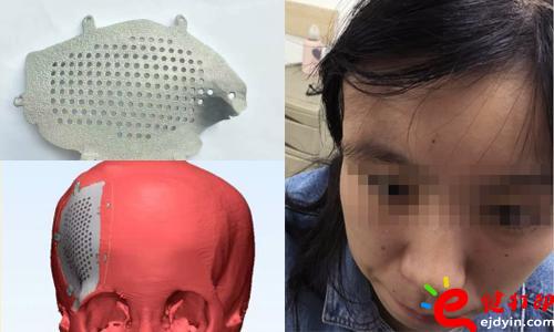 醫(yī)療3d打印應(yīng)用,醫(yī)用3d打印,3D打印假肢,3D打印脊椎,3D打印心臟,e鍵打印,3d打印服務(wù) 3D打印的顱骨假體，非常適用于發(fā)際外的顱骨缺損、病變置換，將使患者的面容恢復到正常形態(tài)，完美解決了傳統(tǒng)顱骨修補存在的美容問題。據(jù)悉，3D打印個性化顱骨假體修補技術(shù)已獲國家重點研發(fā)計劃資助，能為一批病人免費提供假體，并能減免一些檢查和治療費用。未來將實行72小時的3D假體個性化顱骨修補術(shù)，造福更多的患者。